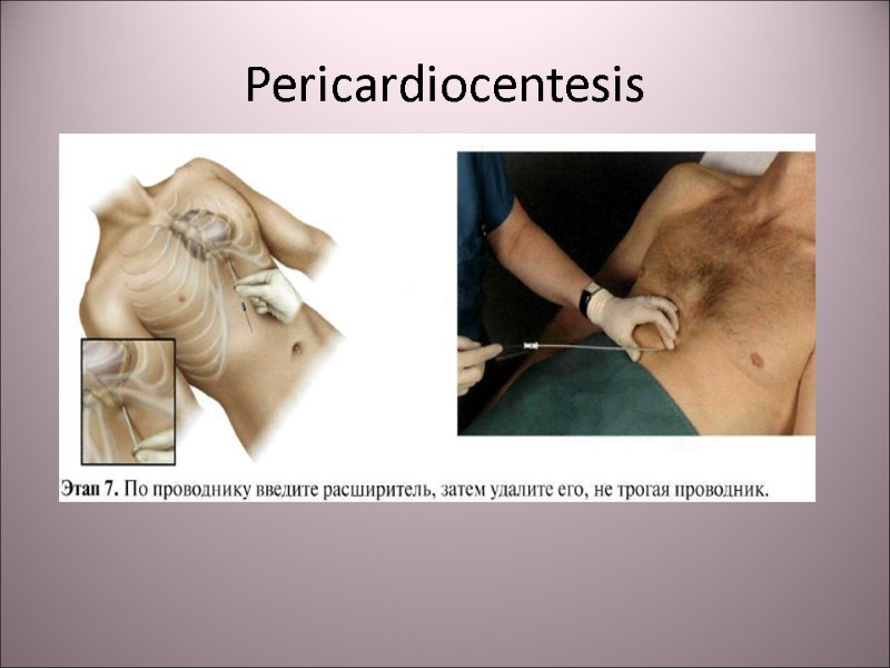 Pericardiocentesis